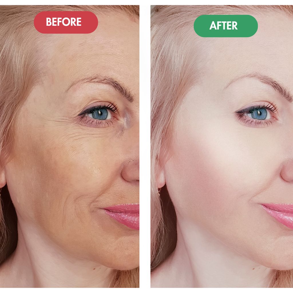 Sagging Cheeks and Jawline